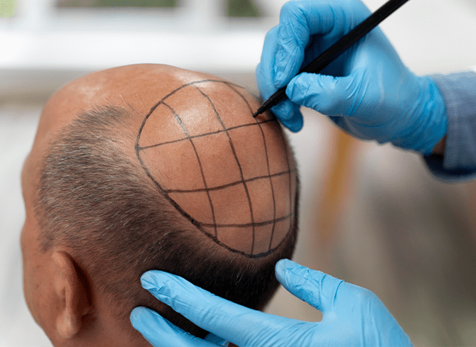 برترین خدمات کاشت مو و ابرو