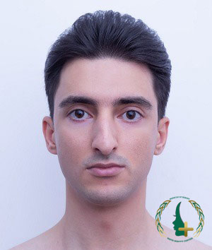 انتخاب بهترین جراح ترمیم بینی با استفاده از آنالیز سه بعدی چهره برای نتایج دقیق‌تر