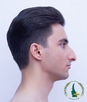 کاشت مو و ابرو با جدیدترین تکنولوژی‌های آنالیز سه‌بعدی در کلینیک زیبایی مایا