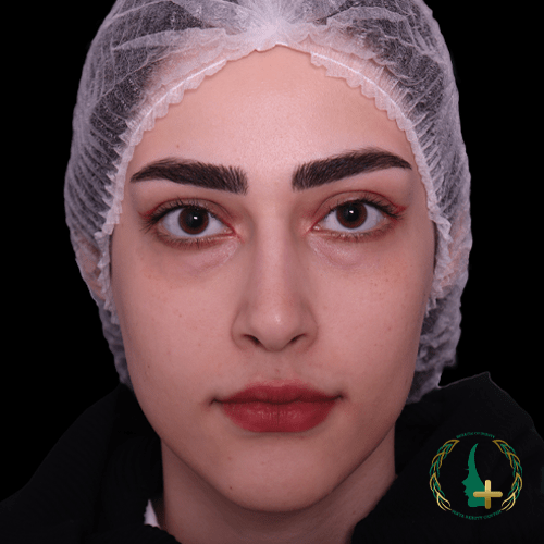 جراحی بینی بدون نقاهت و بدون تامپون با جدیدترین تکنولوژی‌های آنالیز سه‌بعدی