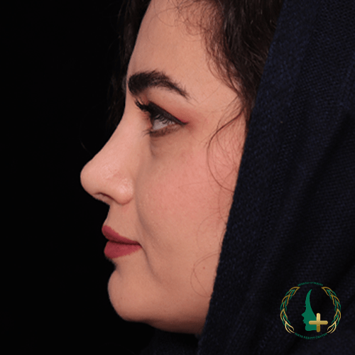 جراحی بینی بدون تامپون و نقاهت در کلینیک زیبایی مایا با بهترین جراح ترمیم بینی