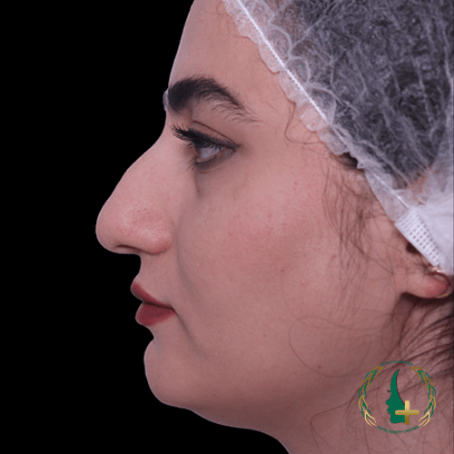 کلینیک زیبایی مایا، پیشرو در انجام عمل بینی بدون نقاهت و با آنالیز سه‌بعدی چهره.