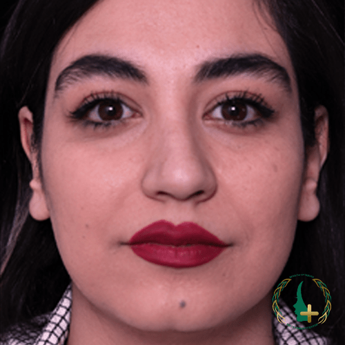 در کلینیک زیبایی مایا، آنالیز سه‌بعدی چهره قبل از هر عمل بینی انجام می‌شود