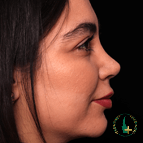 کلینیک زیبایی مایا ارائه‌دهنده جراحی بینی بدون تامپون با آنالیز سه‌بعدی چهره.