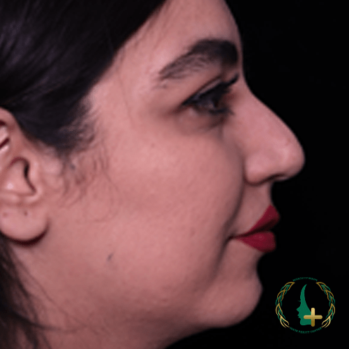 بهترین جراح ترمیم بینی در کلینیک زیبایی مایا، با تکنیک‌های مدرن عمل بینی بدون نقاهت