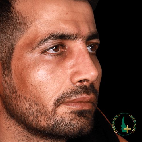 بهترین روش‌های عمل بینی بدون تامپون با بهره‌گیری از آنالیز سه بعدی چهره در مرکز زیبایی مایا