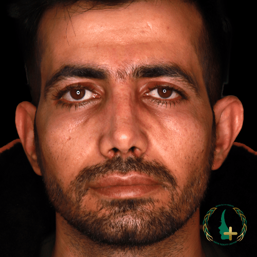 بهترین جراح ترمیم بینی در کلینیک زیبایی مایا با عمل بینی بدون تامپون و بدون نقاهت در خدمت شماست