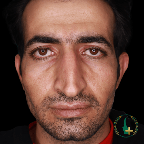 بهره‌گیری از آنالیز سه‌بعدی چهره، بهترین جراح ترمیم بینی