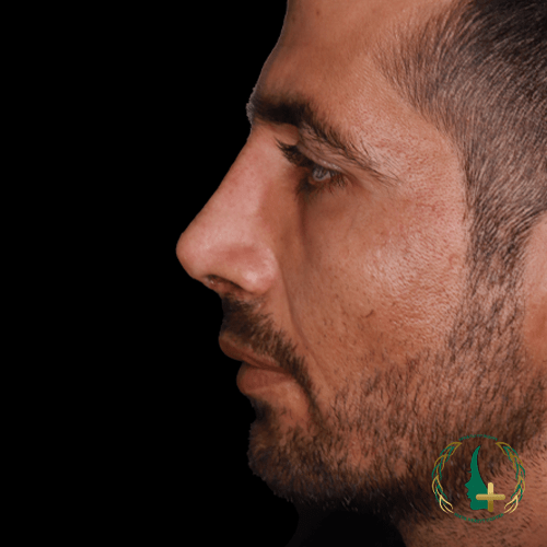 کلینیک زیبایی مایا ارائه‌دهنده عمل بینی بدون نقاهت و بهترین جراح ترمیم بینی با استفاده از آنالیز سه‌بعدی چهره