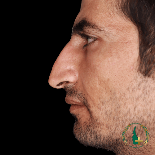 جراحی بینی با تکنولوژی آنالیز بدون تامپون سه‌بعدی چهره