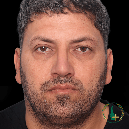 جراحی بینی بدون تامپون با استفاده از تکنیک آنالیز سه‌بعدی چهره در کلینیک زیبایی مایا