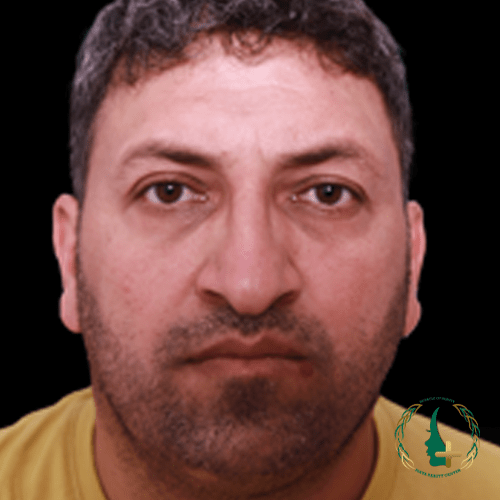 بهترین جراح ترمیم بینی با عمل بینی بدون تامپون و بدون نقاهت در کلینیک زیبایی مایا