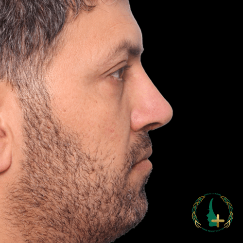 کاهش نقاهت با جراحی بینی در مرکز زیبایی مایا بدون تامپون و آنالیز سه بعدی چهره