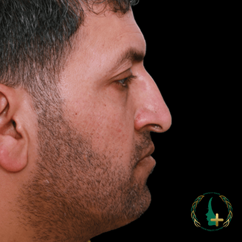 عمل بینی در کلینیک زیبایی مایا با استفاده از آنالیز سه بعدی برای نتایج بهتر