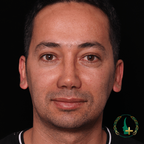 جراحی بینی بدون تامپون با نتایج بهبود یافته از طریق آنالیز سه بعدی در مرکز زیبایی مایا