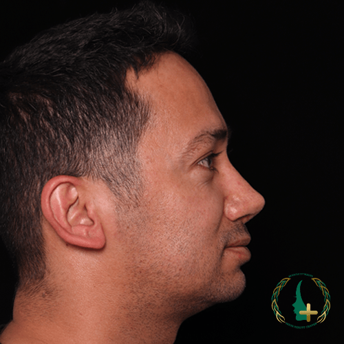 آنالیز سه بعدی چهره در جراحی بینی برای کاهش نقاهت و بهبود نتایج در مرکز زیبایی مایا