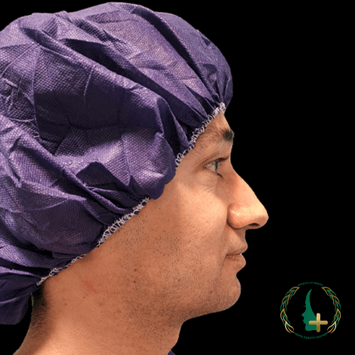 عمل بینی بدون نقاهت با استفاده از آنالیز دقیق چهره در مرکز زیبایی مایا