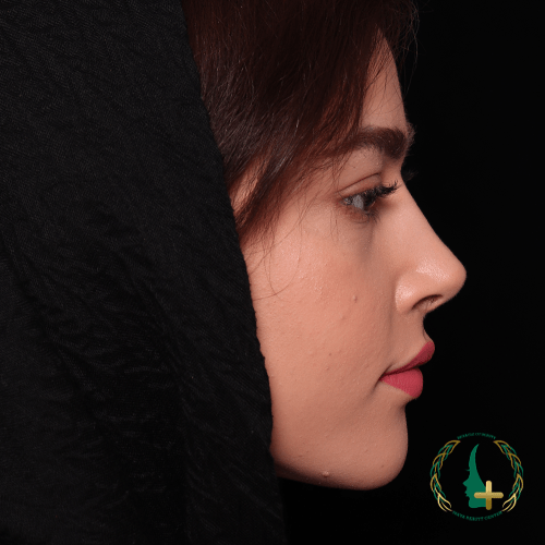 جراحی بینی بدون نقاهت با کمک آنالیز سه‌بعدی چهره در کلینیک زیبایی مایا