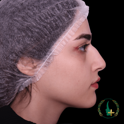 جراحی بینی بدون نقاهت با کمک آنالیز سه‌بعدی چهره در کلینیک زیبایی مایا