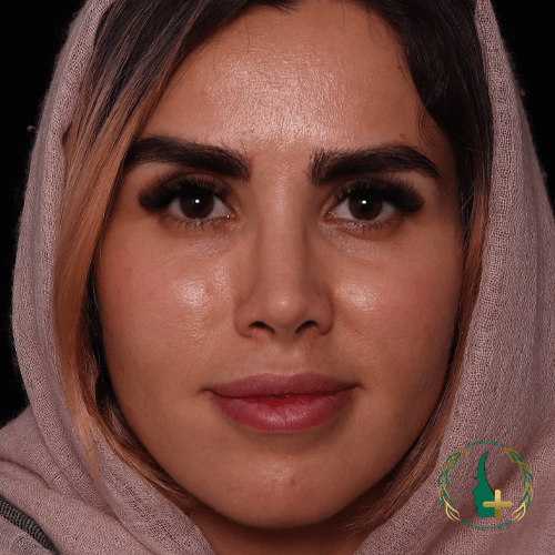 عمل بینی بدون تامپون و نقاحت کمتر در مرکز زیبایی مایا با استفاده از آنالیز سه بعدی چهره