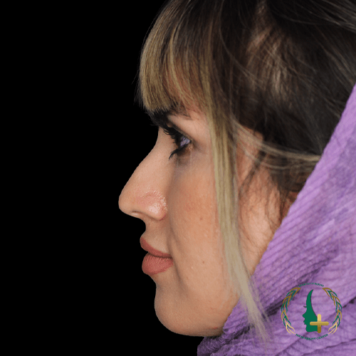 جراحی بینی با استفاده از آنالیز سه بعدی چهره در کلینیک زیبایی مایا