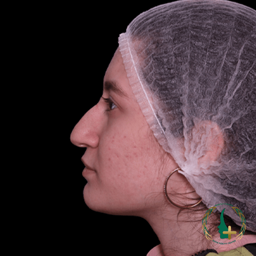 جراحی بینی در کلینیک زیبایی مایا بدون تامپون و با استفاده از آنالیز پیشرفته