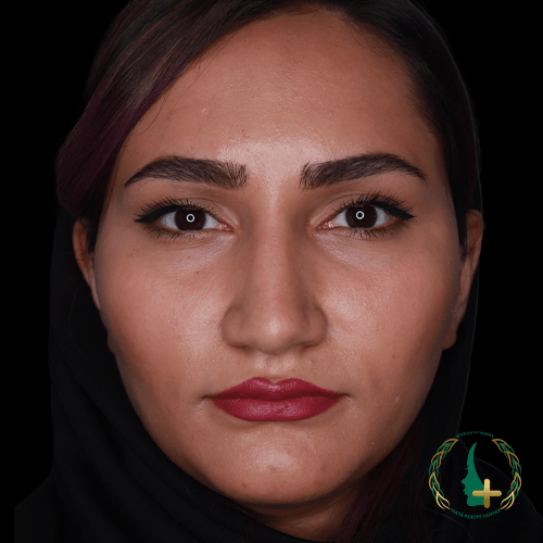 آنالیز سه بعدی چهره در کلینیک مایا برای عمل بینی با کمترین نقاحت و بهبود سریع‌تر