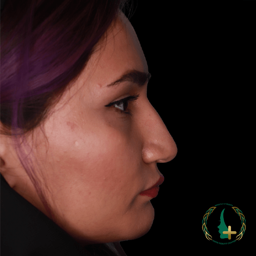 آنالیز سه بعدی چهره برای بهبود نتایج جراحی بینی بدون تامپون