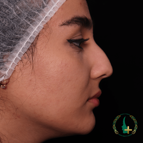 عمل بینی بدون تامپون با آنالیز دقیق چهره به صورت سه بعدی در کلینیک زیبایی مایا