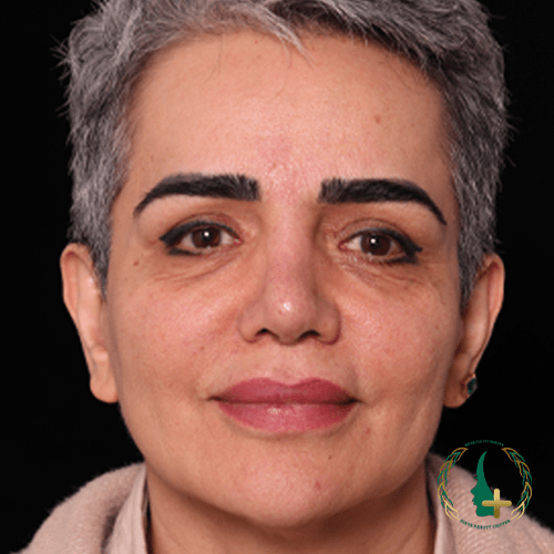 آنالیز سه‌بعدی چهره برای دقت بالاتر در عمل بینی بدون نقاهت