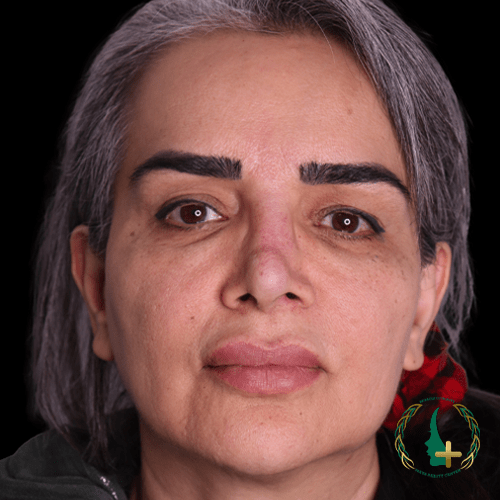 کلینیک زیبایی مایا پیشگام در ارائه جراحی بینی بدون تامپون با بهترین جراح ترمیم بینی.