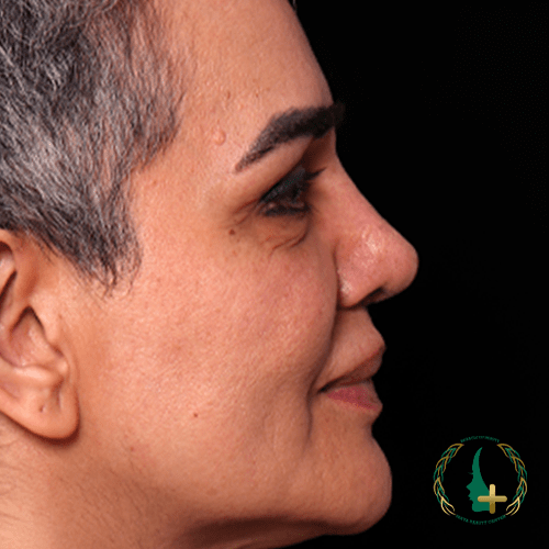 جراحی بینی بدون نقاهت و تامپون با بهترین کیفیت و استفاده از آنالیز سه‌بعدی چهره.