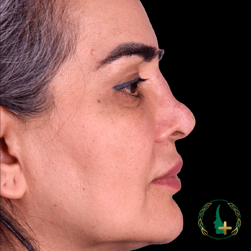 جراحی بینی بدون نقاهت و تامپون با بهترین کیفیت و استفاده از آنالیز سه‌بعدی چهره.