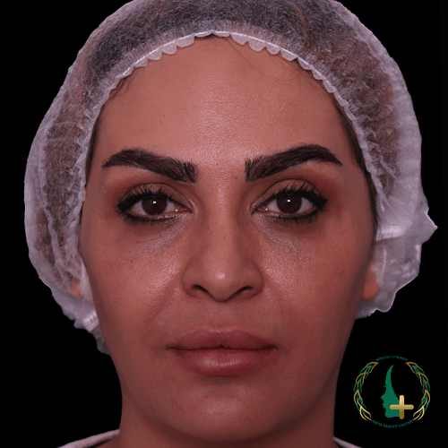 جراحی بینی بدون نقاهت در کلینیک زیبایی مایا با بهره‌گیری از بهترین جراح ترمیم بینی