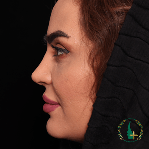 جراحی بینی بدون تامپون با آنالیز سه‌بعدی چهره در کلینیک زیبایی مایا، تجربه‌ای متفاوت