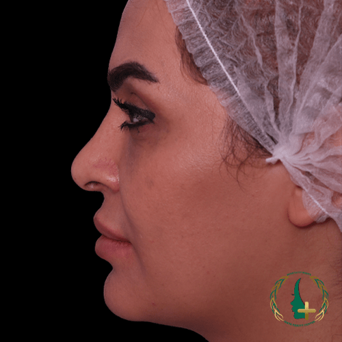 بهترین جراح ترمیم بینی در کلینیک زیبایی مایا عمل بینی بدون نقاهت را تضمین می‌کند.