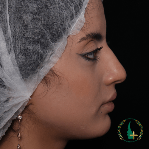 جراحی بینی با آنالیز سه‌بعدی