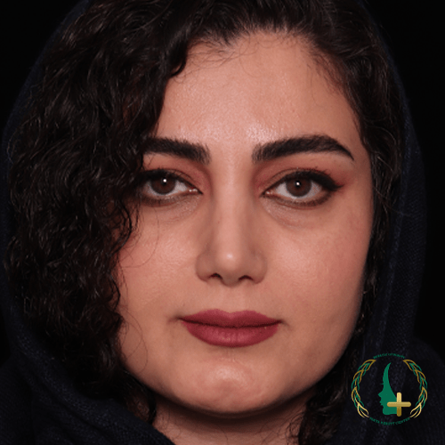 بهترین جراح ترمیم بینی با استفاده از تکنیک‌های نوین جراحی بینی بدون تامپون