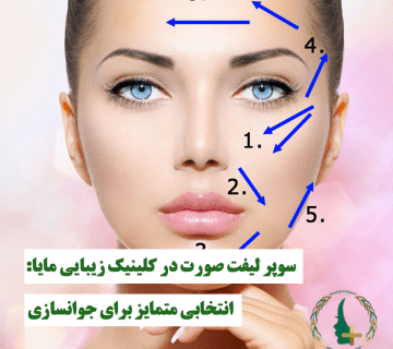 سوپر لیفت صورت