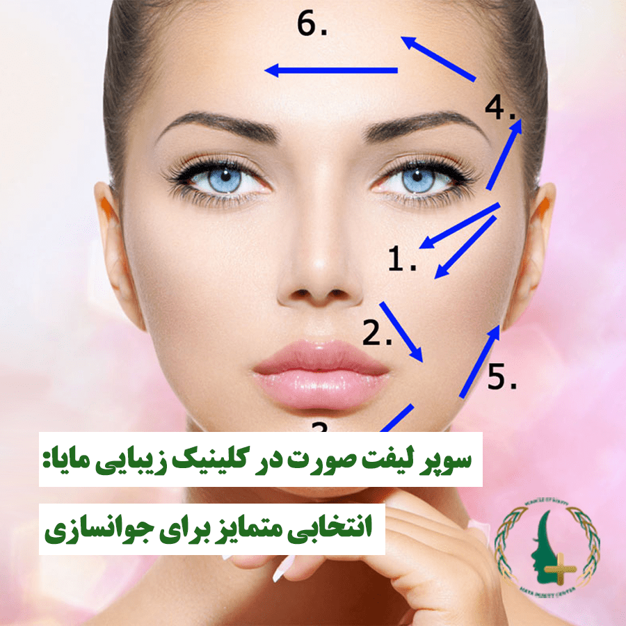 سوپر لیفت صورت