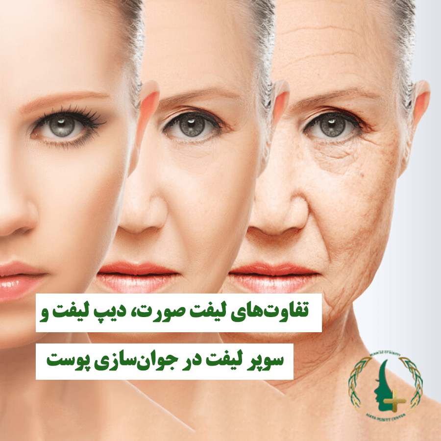 لیفت صورت، دیپ لیفت و سوپر لیفت در جوان‌سازی پوست