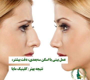 عمل بینی با اسکن سه‌بعدی، دقت بیشتر، نتیجه بهتر | کلینیک مایا