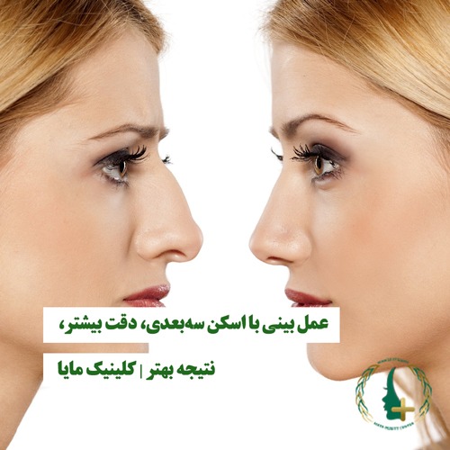 عمل بینی با اسکن سه‌بعدی، دقت بیشتر، نتیجه بهتر | کلینیک مایا